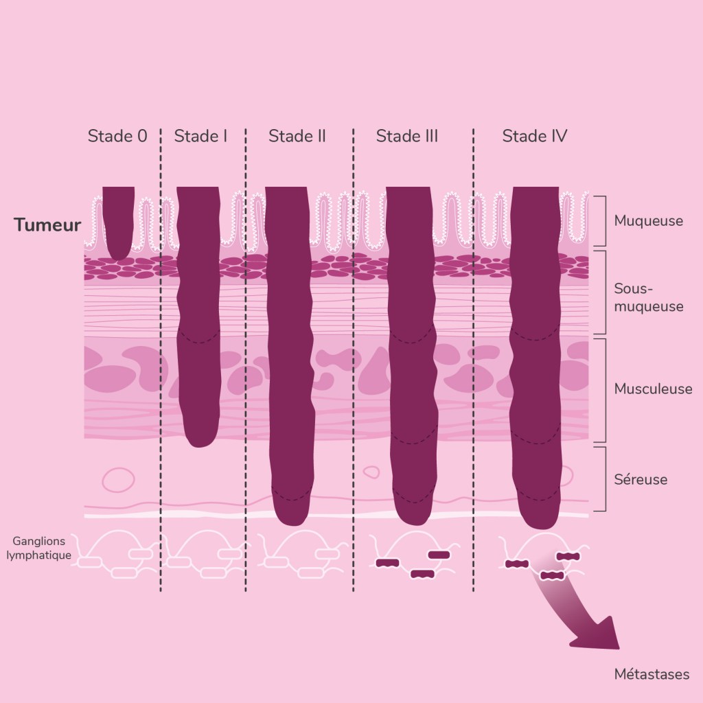 Mécanismes des cancers colorectaux (forme héréditaire, sporadique ...