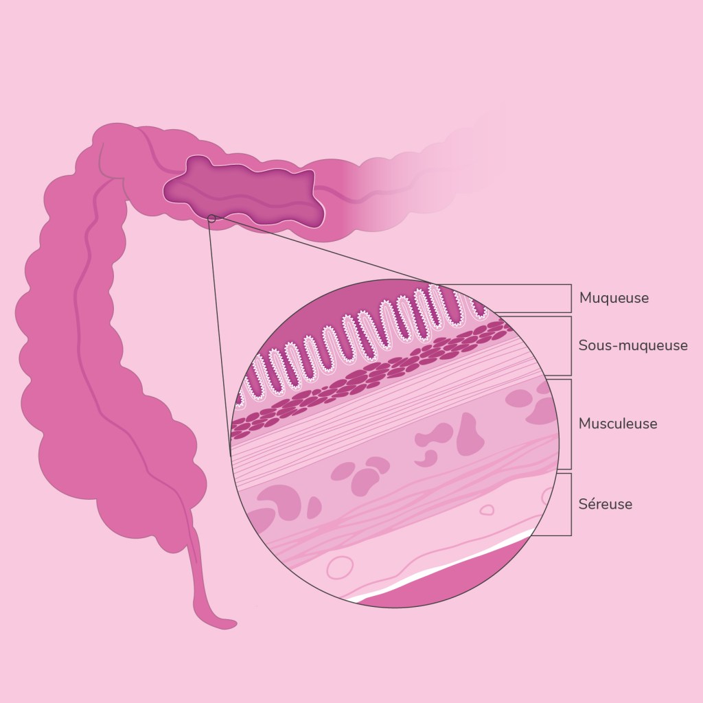 Mécanismes des cancers colorectaux (forme héréditaire, sporadique ...