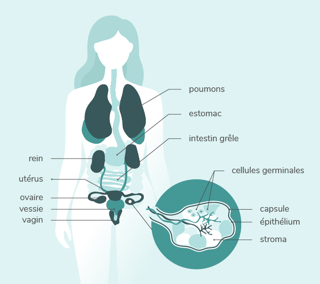 Comprendre les mécanismes du cancer de l'ovaire| Mon Cancer
