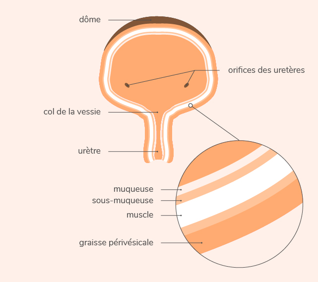 Comprendre les mécanismes du cancer de la vessie | Mon Cancer