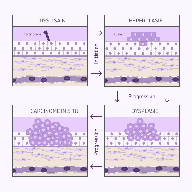 Schéma de l'adénocarcinome