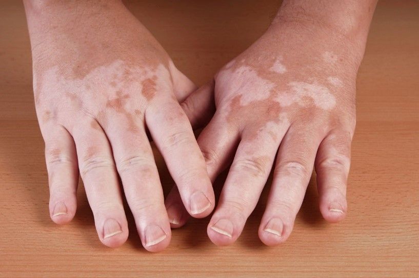 Image d'un vitiligo