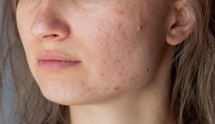 Image d'une éruption cutanée 