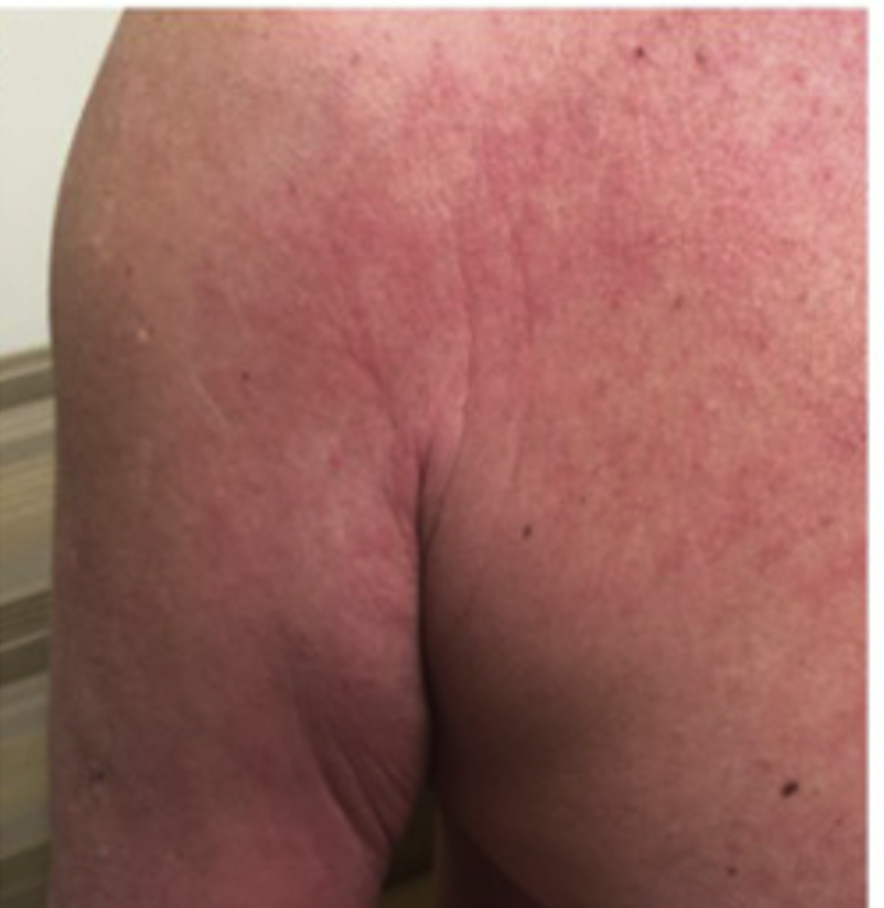 Image d'une éruption cutanée